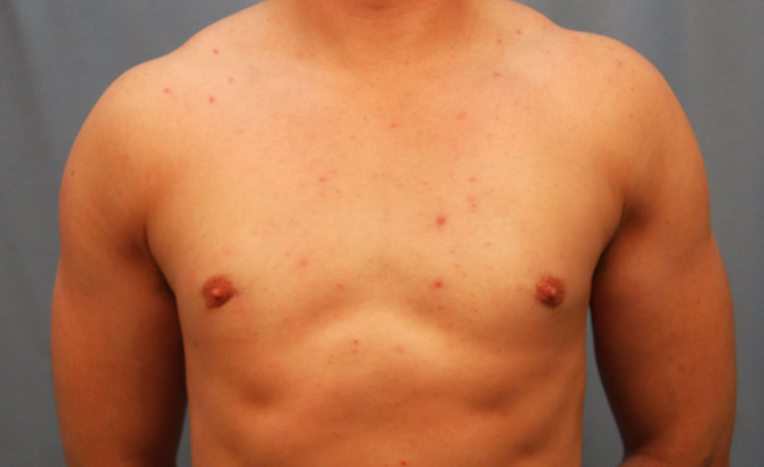 After Image: Gynecomastia - front