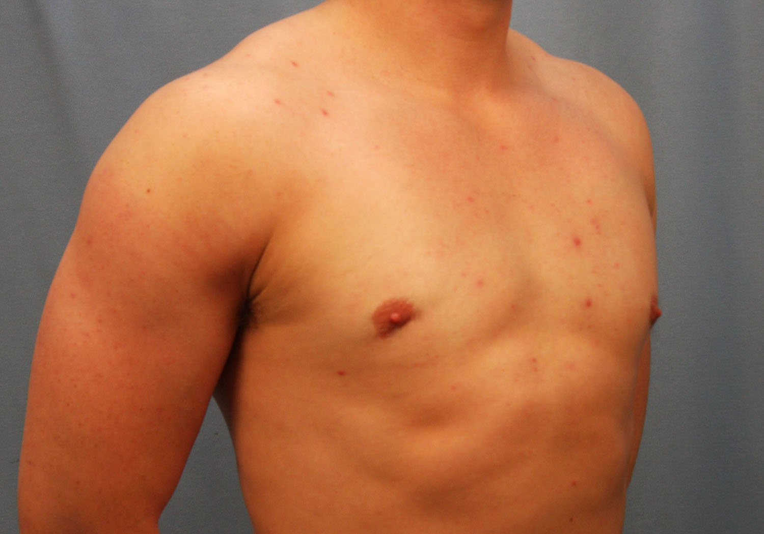 After Image: Gynecomastia - right-front-oblique