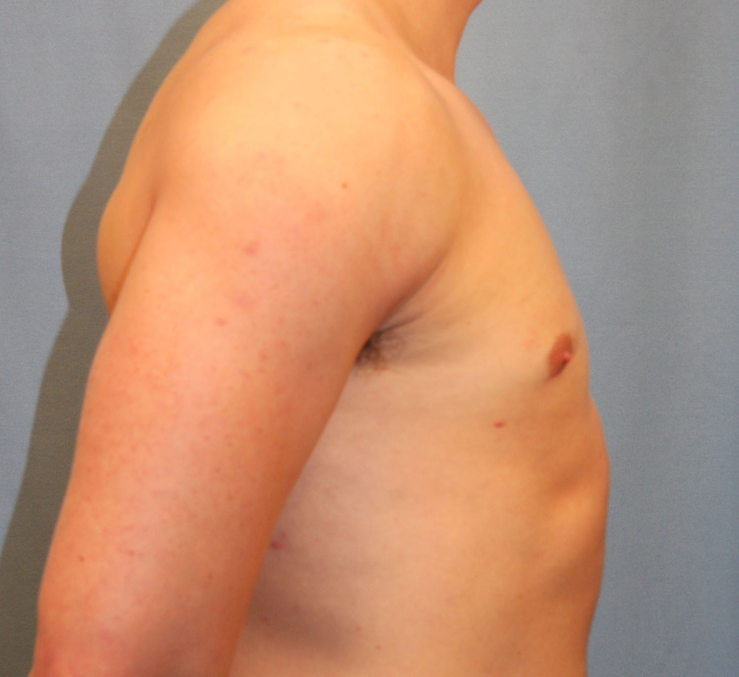 After Image: Gynecomastia - right-side