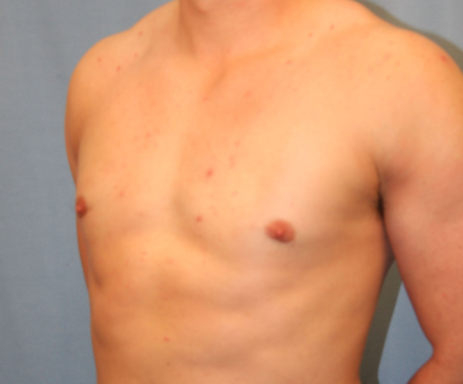 After Image: Gynecomastia - left-front-oblique