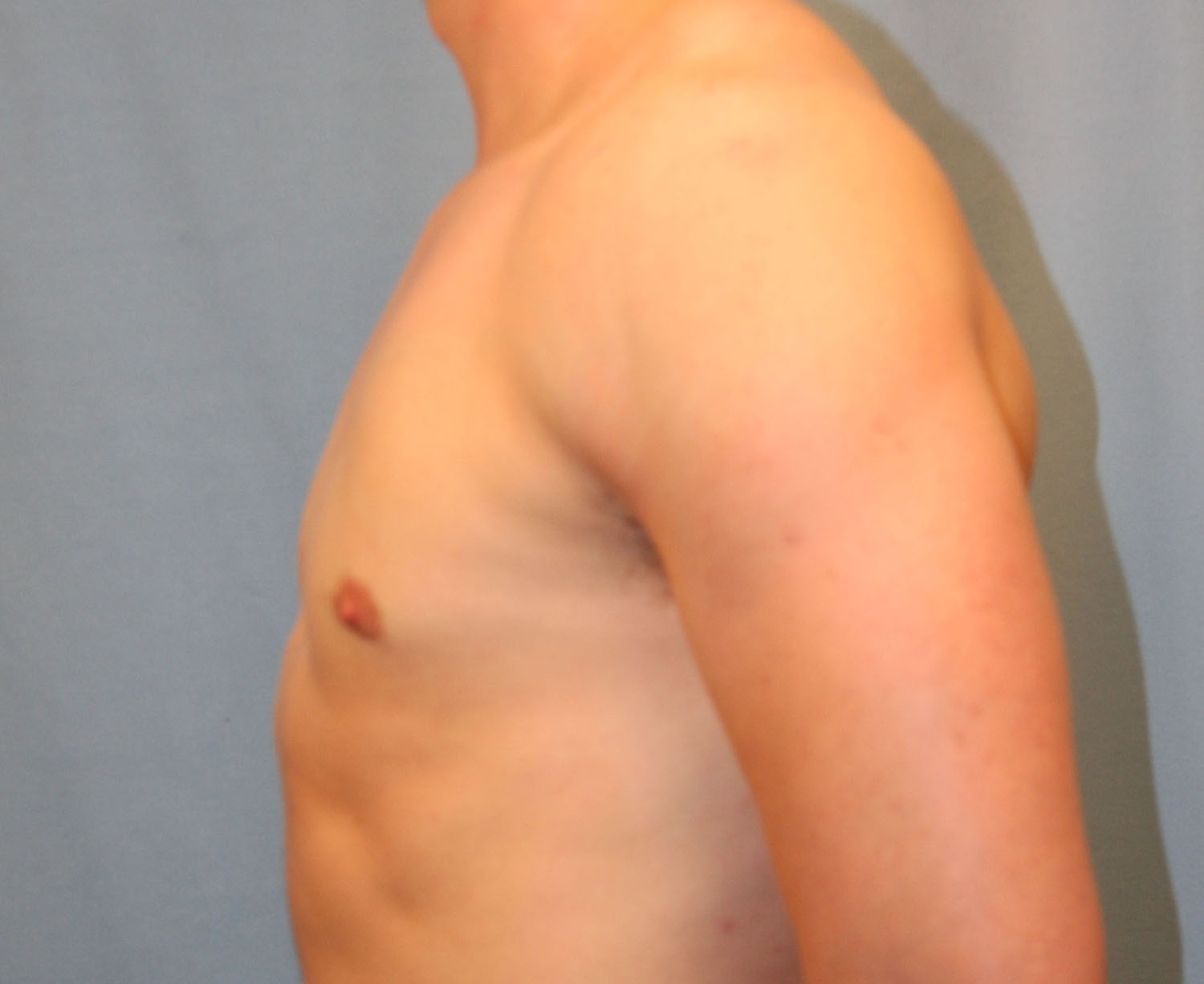 After Image: Gynecomastia - left-side