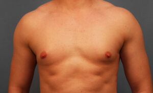Before Image: Gynecomastia