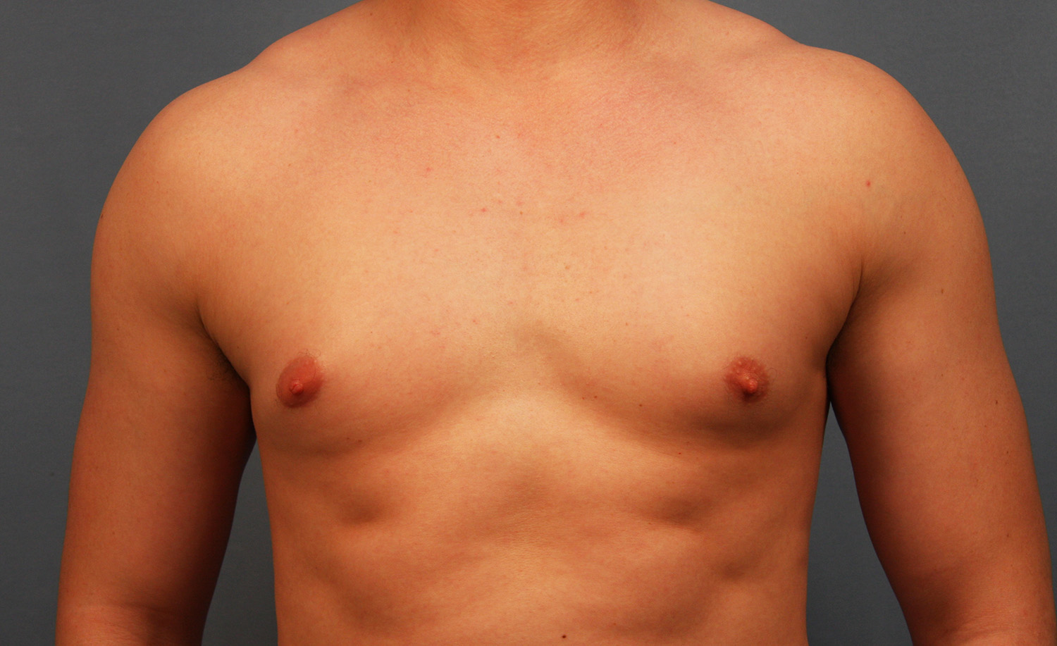 Before Image: Gynecomastia - front