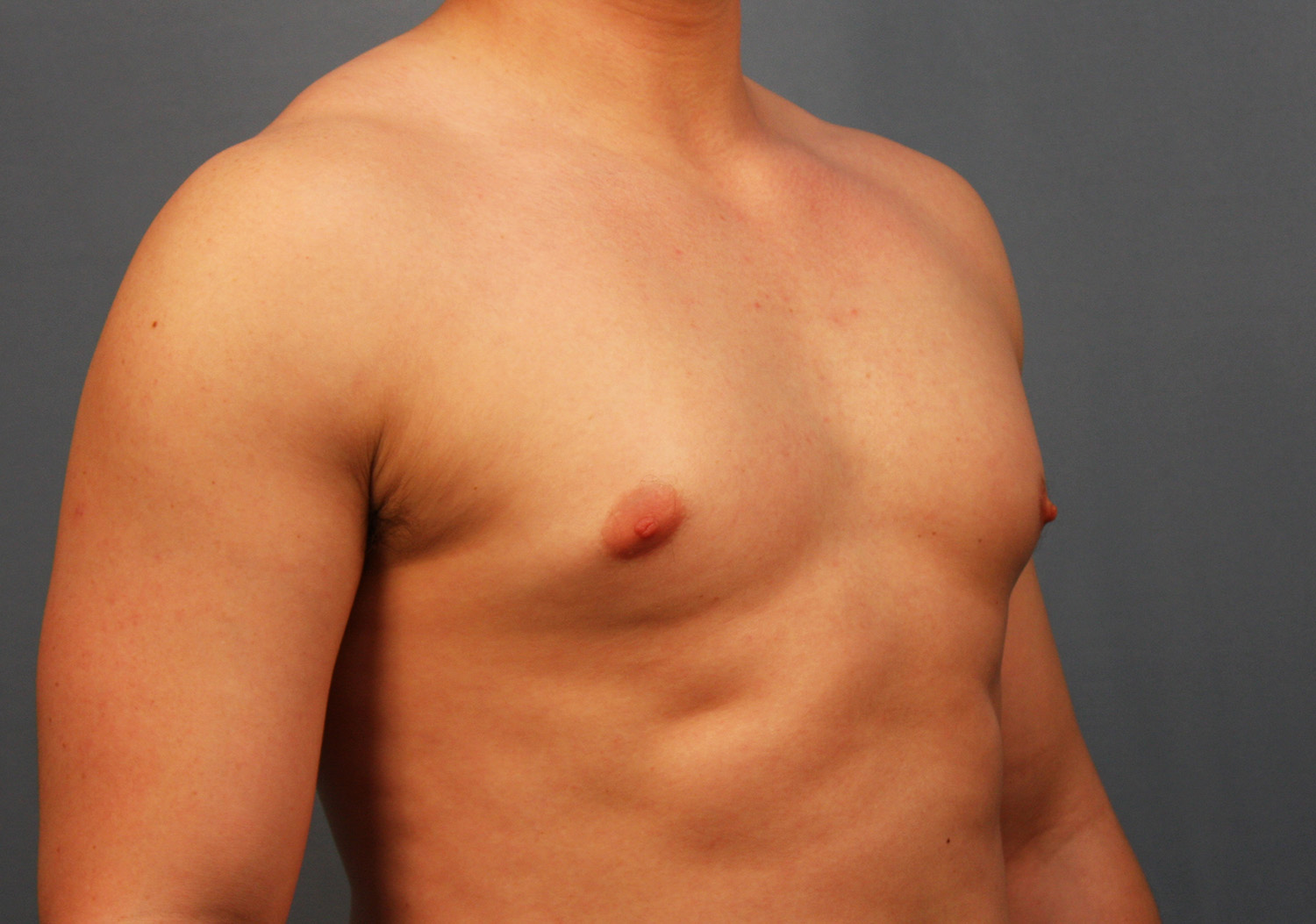 Before Image: Gynecomastia - right-front-oblique