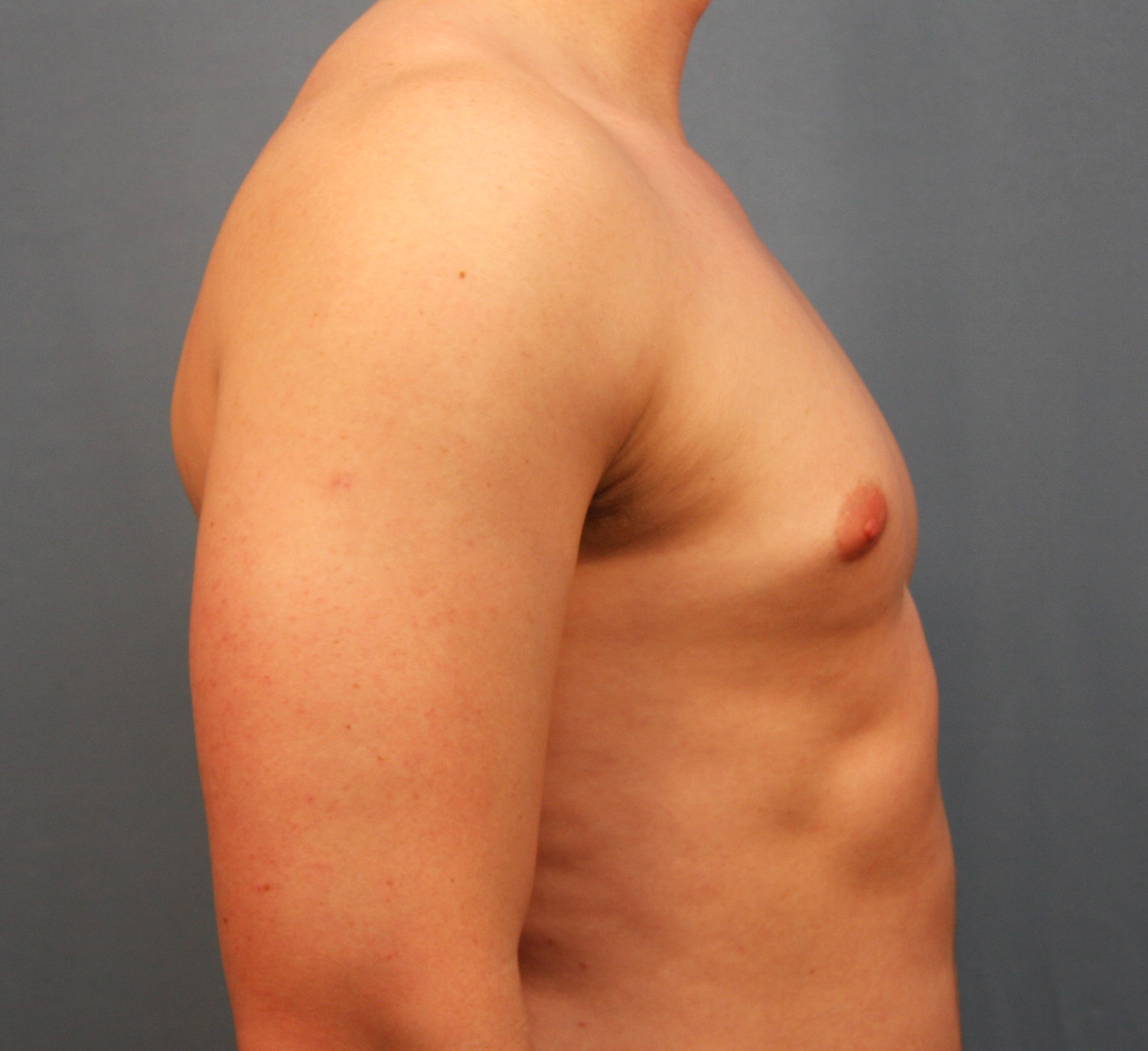 Before Image: Gynecomastia - right-side