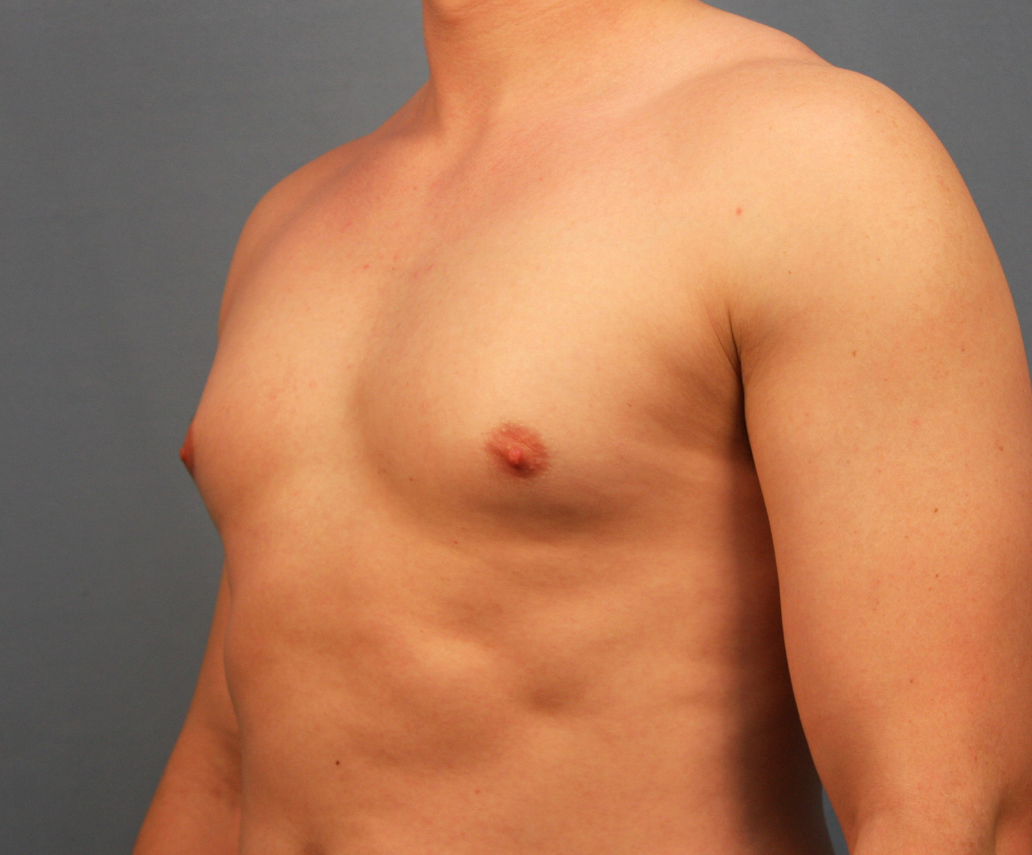 Before Image: Gynecomastia - left-front-oblique