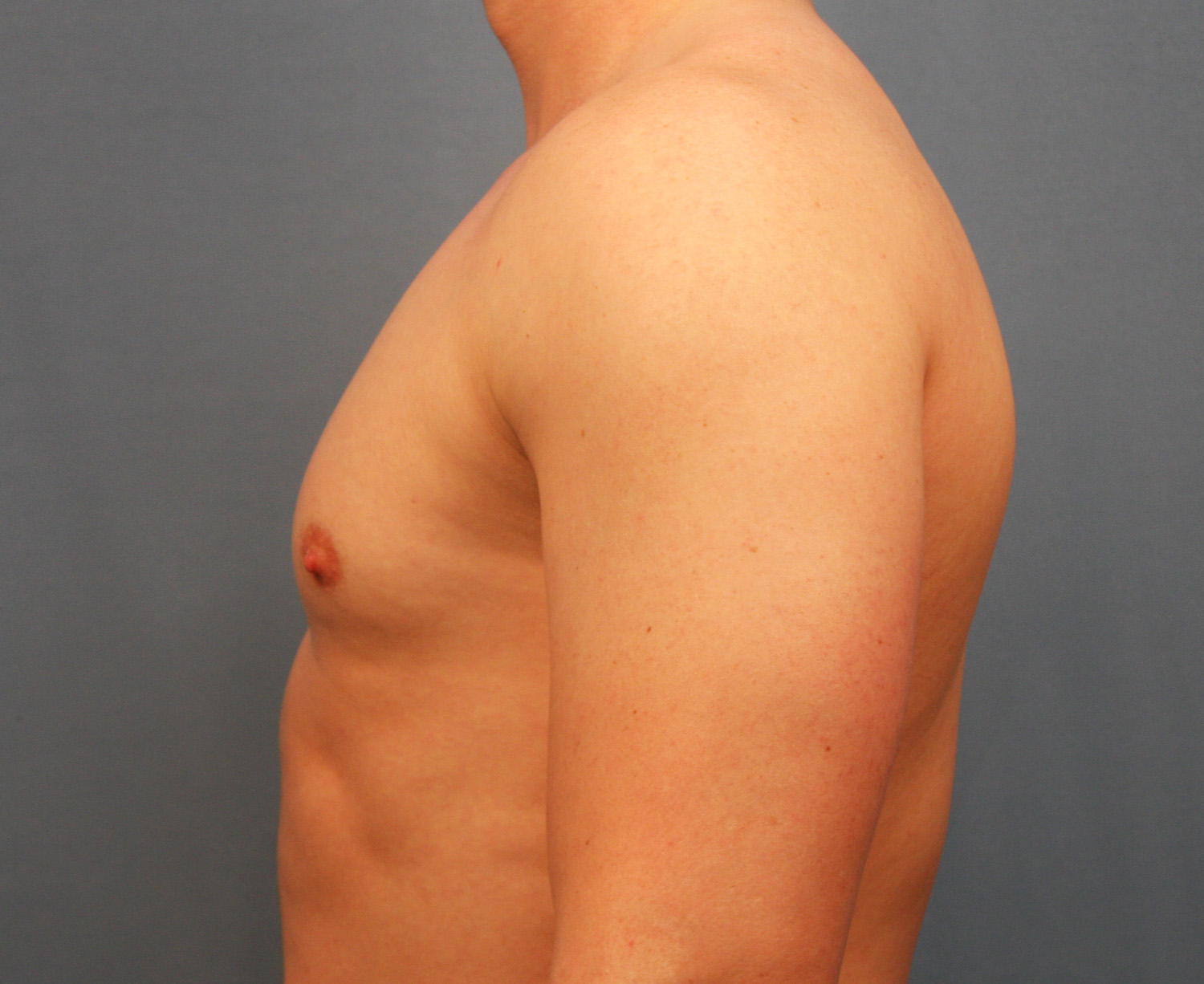 Before Image: Gynecomastia - left-side