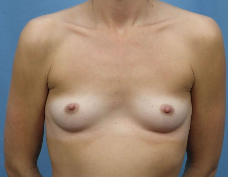 Before Image: Breast Augmentation with Mastopexy - front