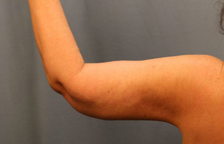 After Image: Brachioplasty - back