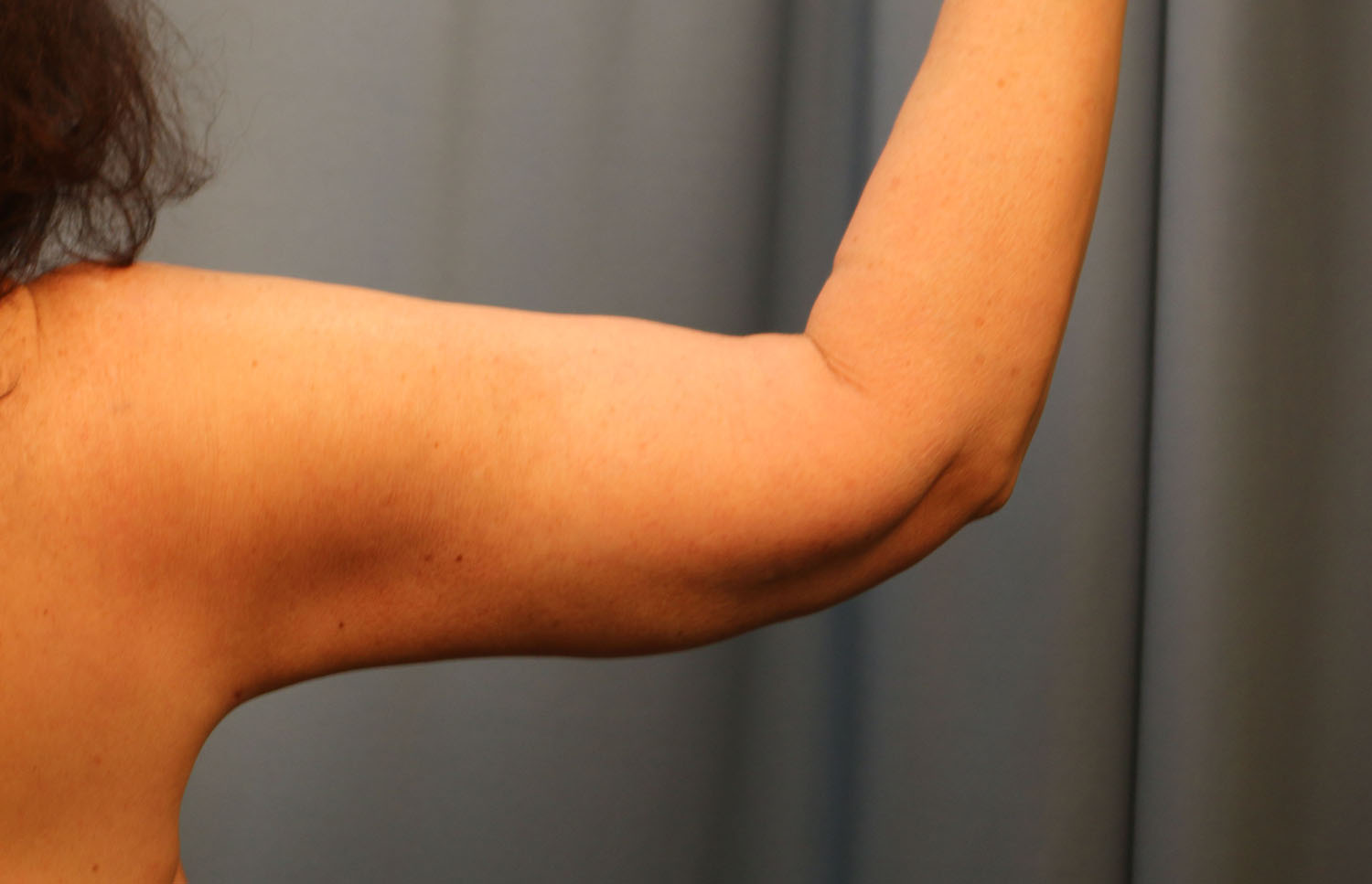 After Image: Brachioplasty - back