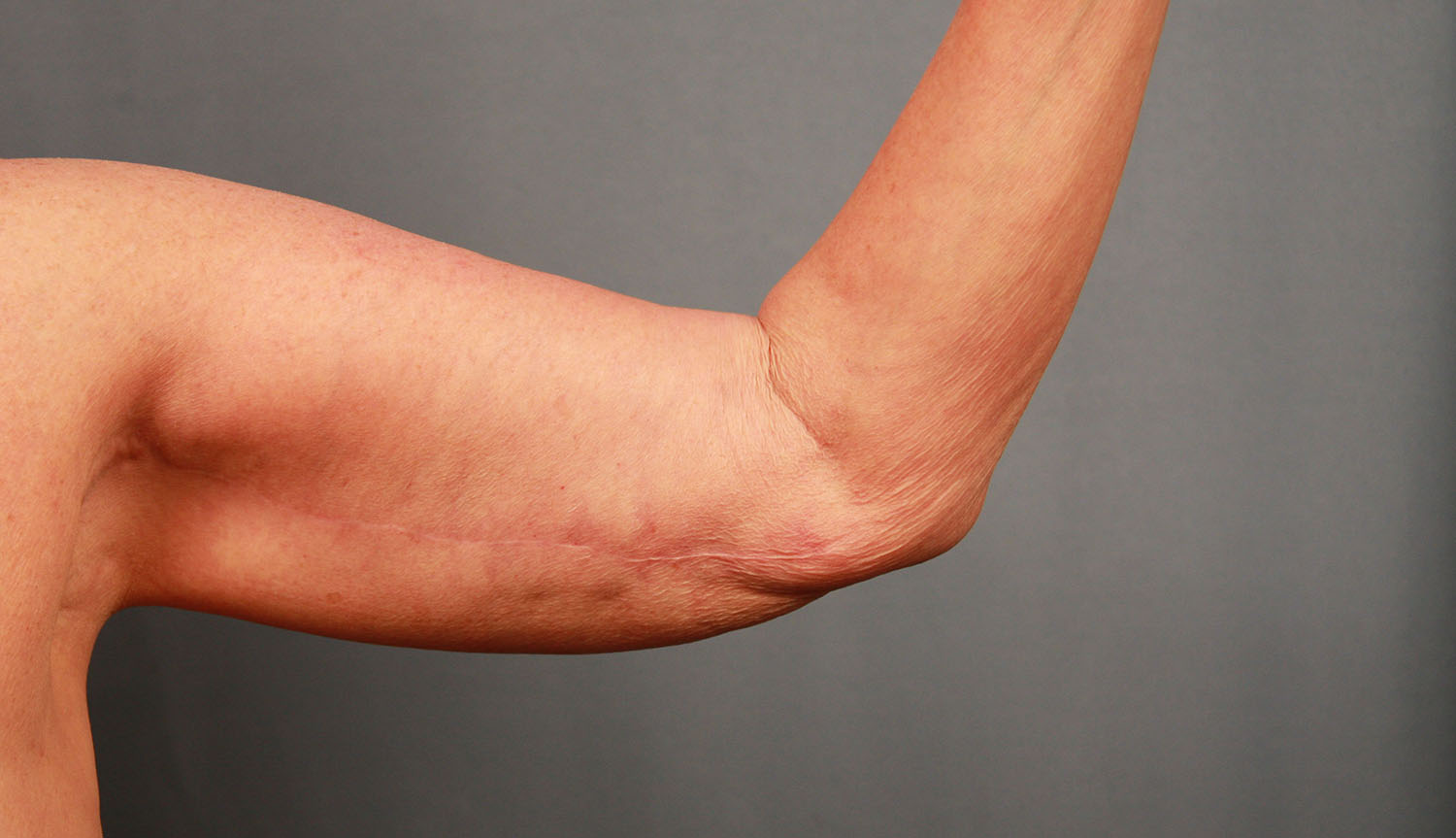 After Image: Brachioplasty - front