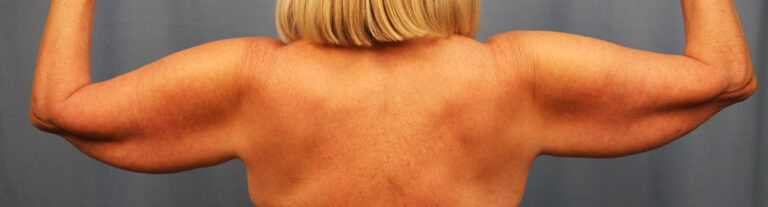 Before Image: Brachioplasty - back