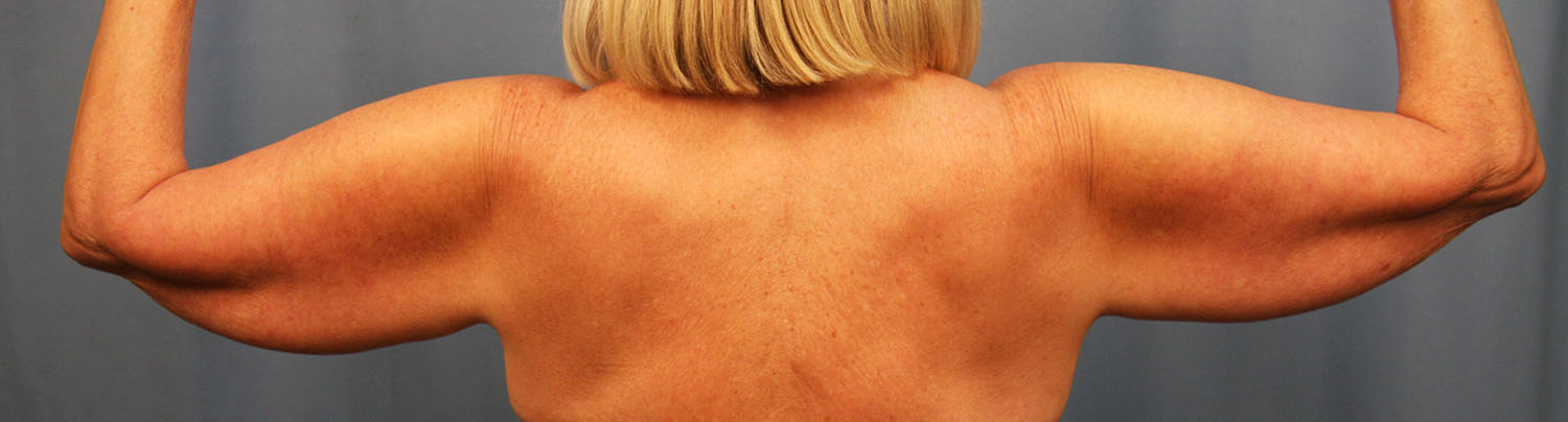 Before Image: Brachioplasty - back