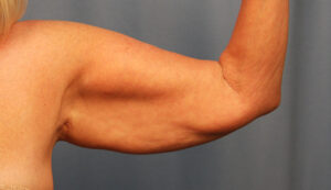 Before Image: Brachioplasty