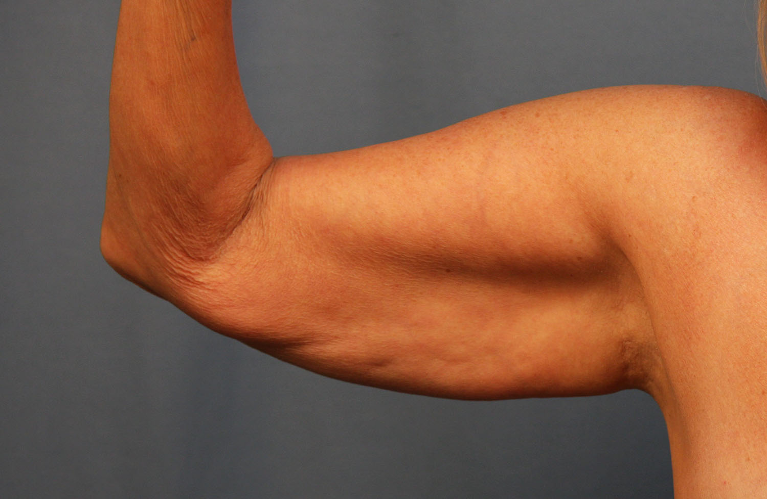 Before Image: Brachioplasty - front