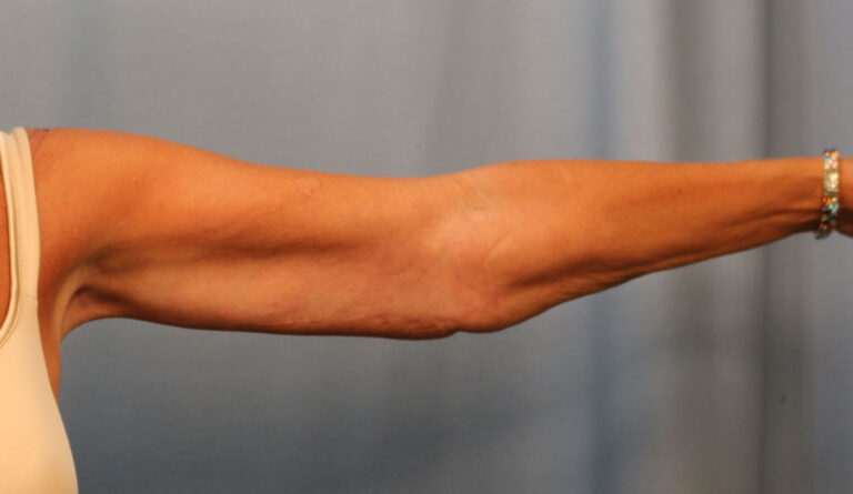 After Image: Brachioplasty - front