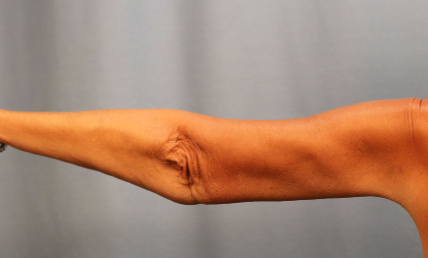 After Image: Brachioplasty - back