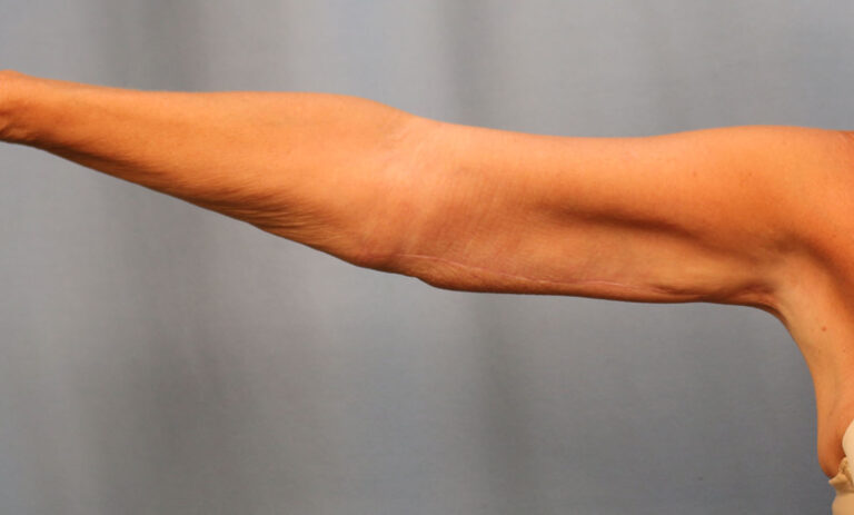 After Image: Brachioplasty - front