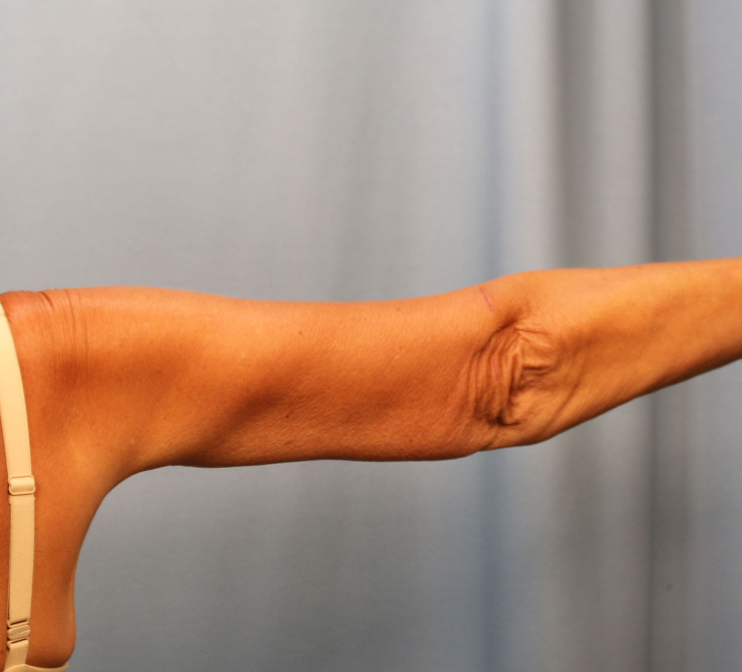 After Image: Brachioplasty - back