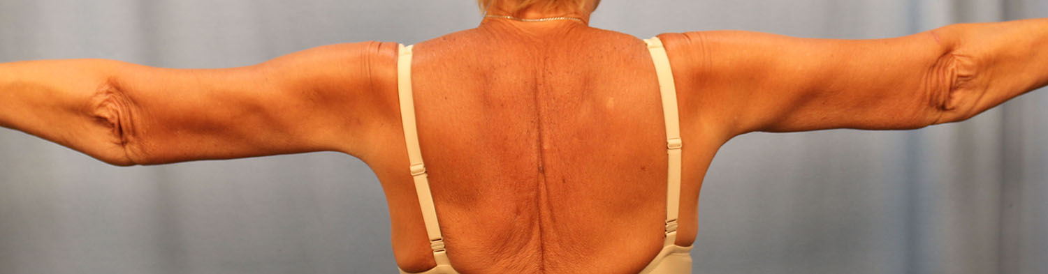 After Image: Brachioplasty - back