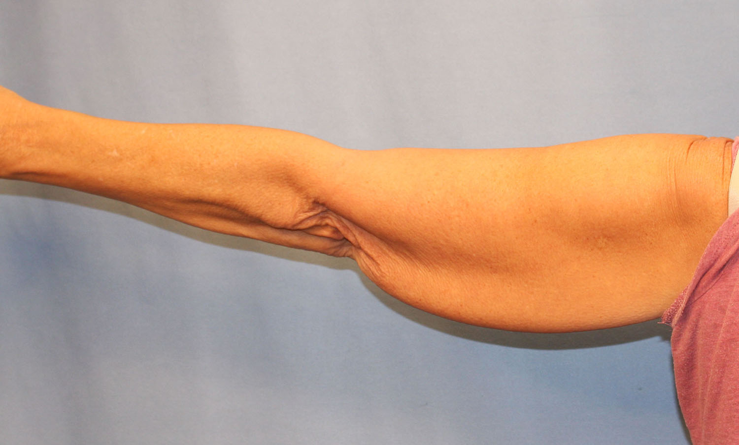 Before Image: Brachioplasty - back