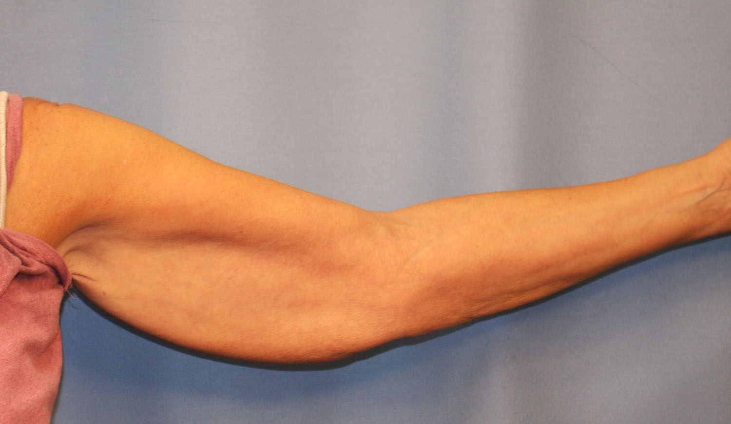 Before Image: Brachioplasty - front