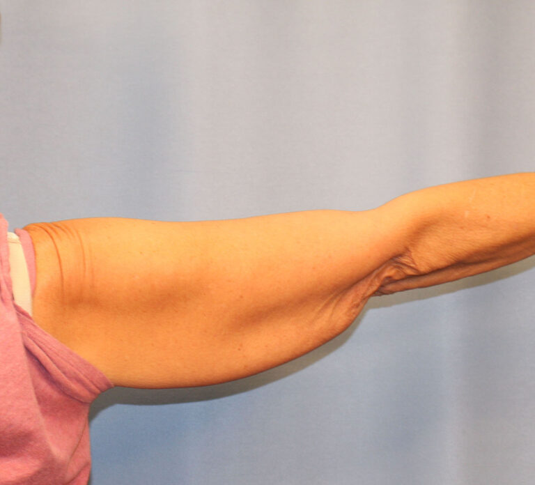 Before Image: Brachioplasty - back