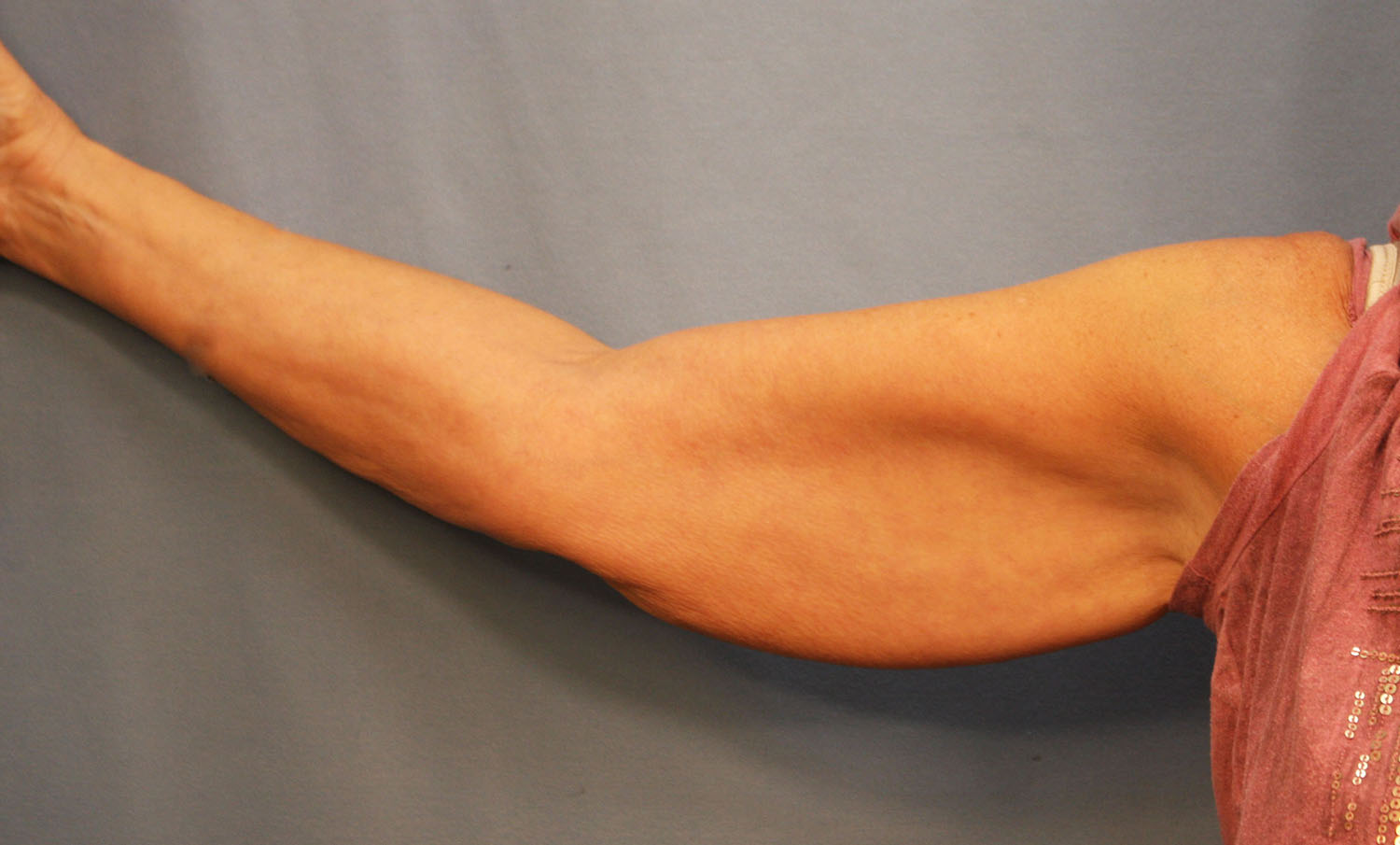 Before Image: Brachioplasty - front