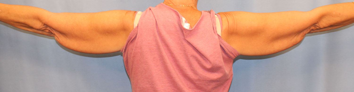 Before Image: Brachioplasty - back
