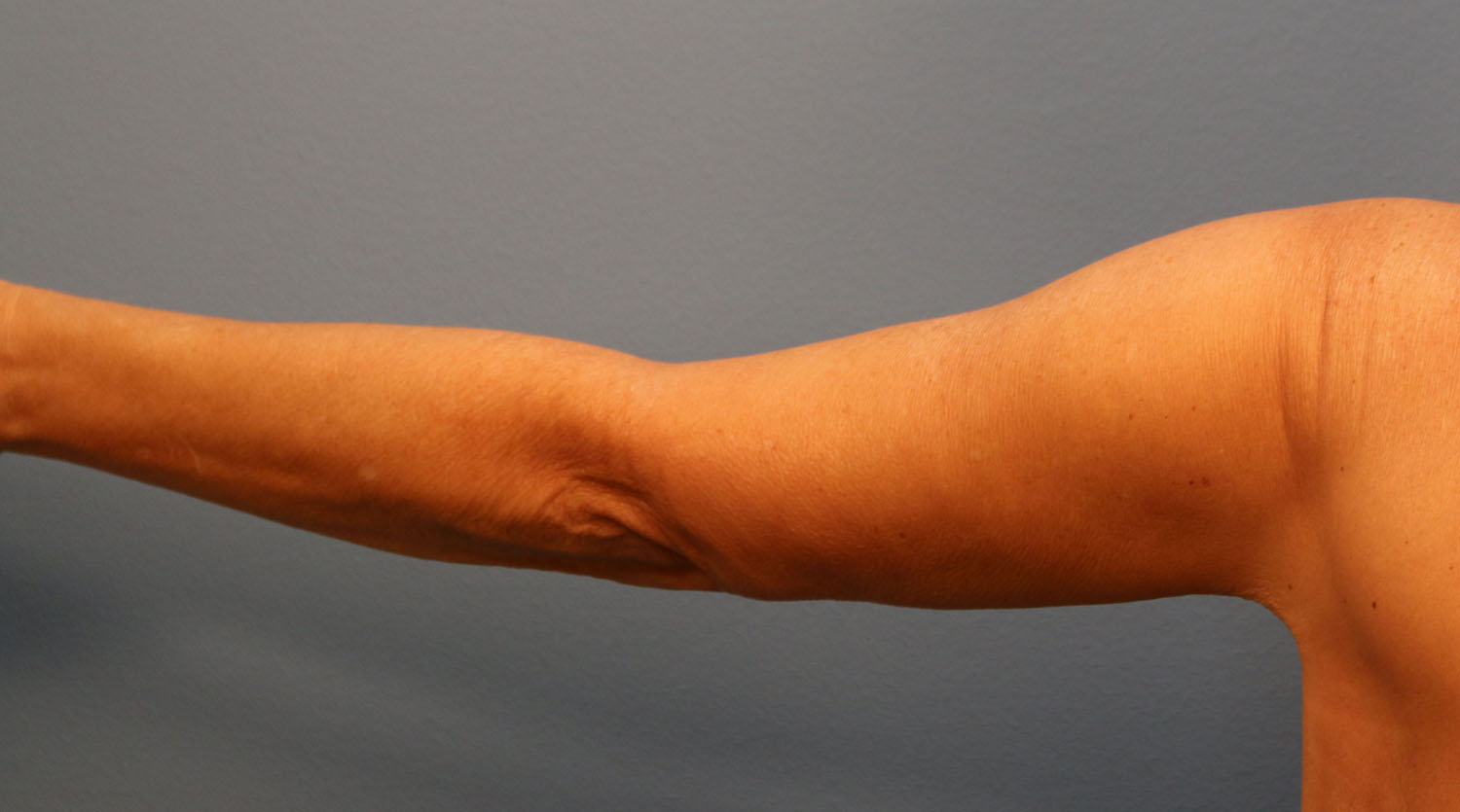 After Image: Brachioplasty - back