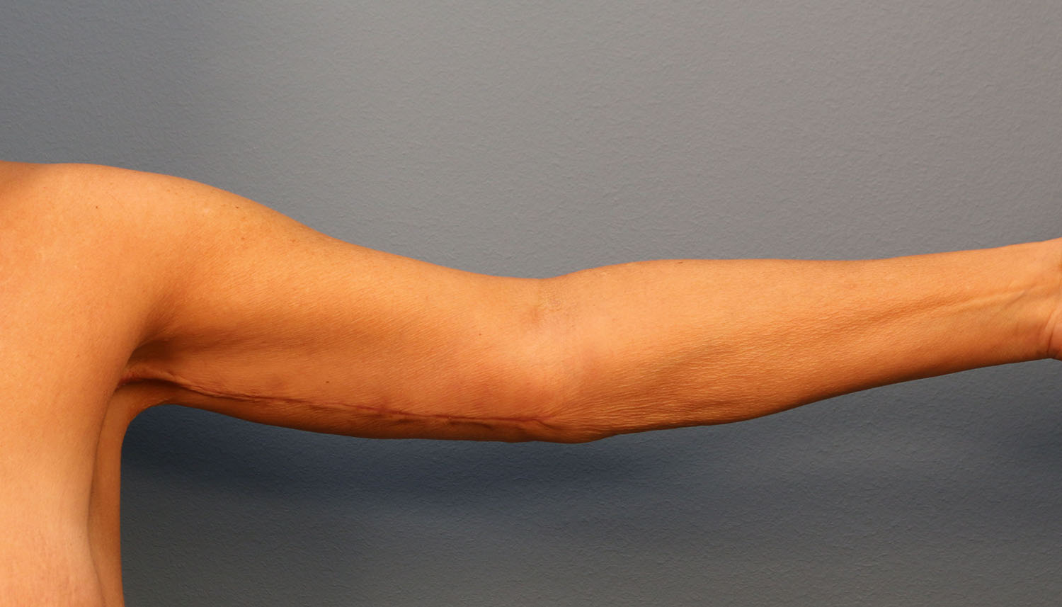 After Image: Brachioplasty - front