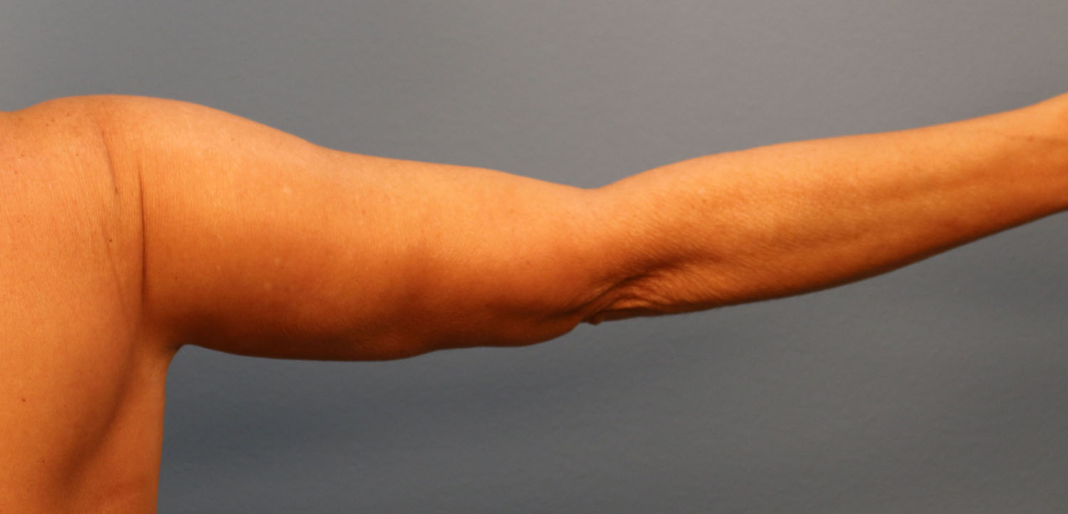 After Image: Brachioplasty - back