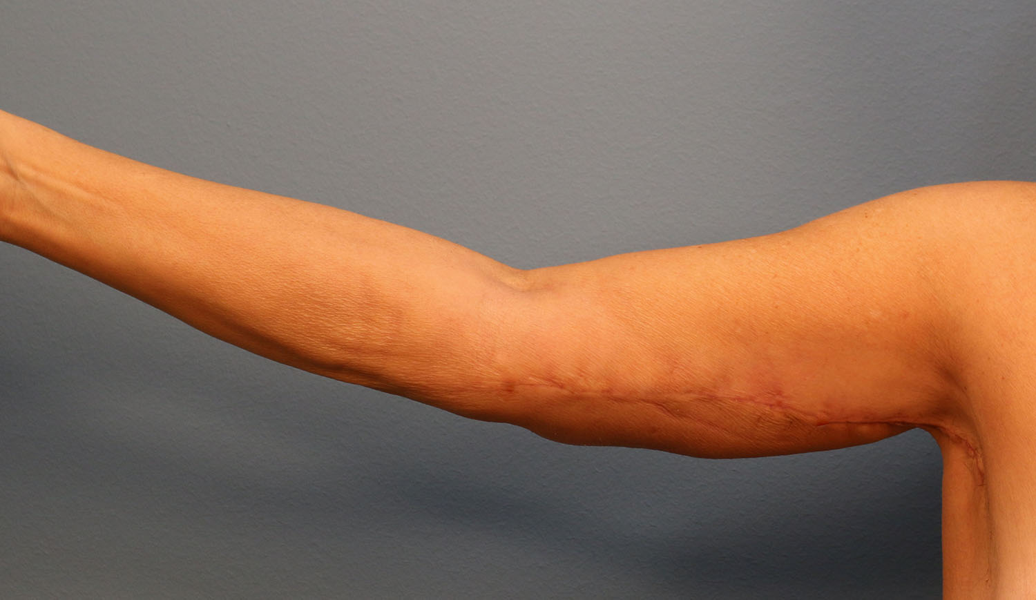 After Image: Brachioplasty - front