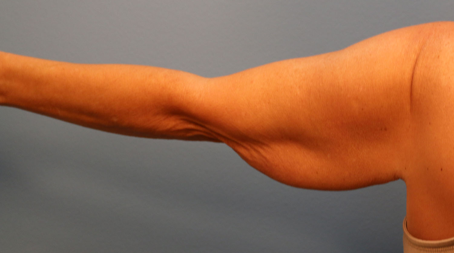 Before Image: Brachioplasty - back
