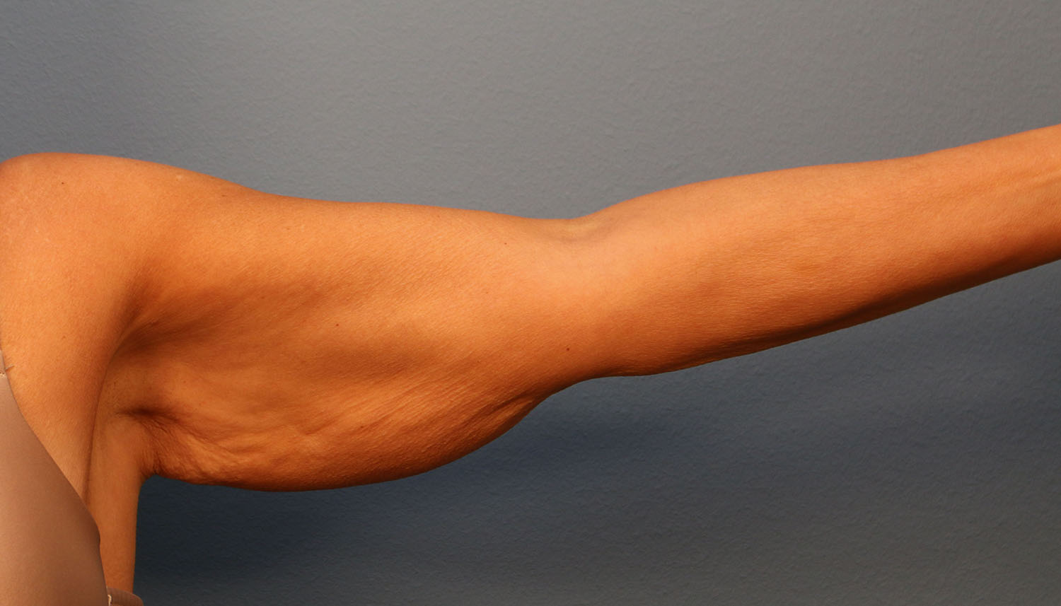Before Image: Brachioplasty - front
