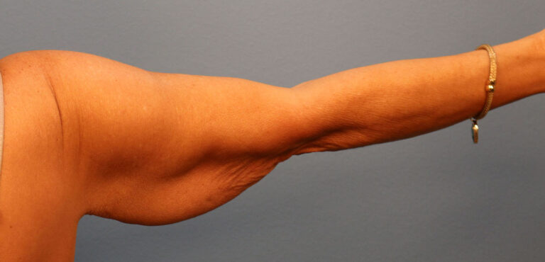 Before Image: Brachioplasty - back