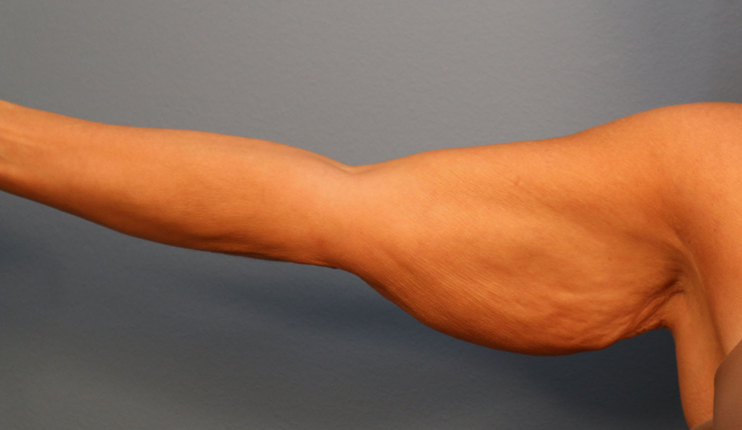 Before Image: Brachioplasty - front