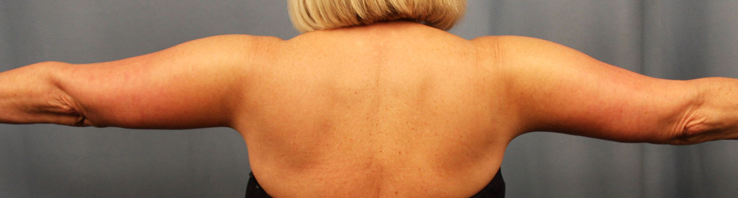 After Image: Brachioplasty - back