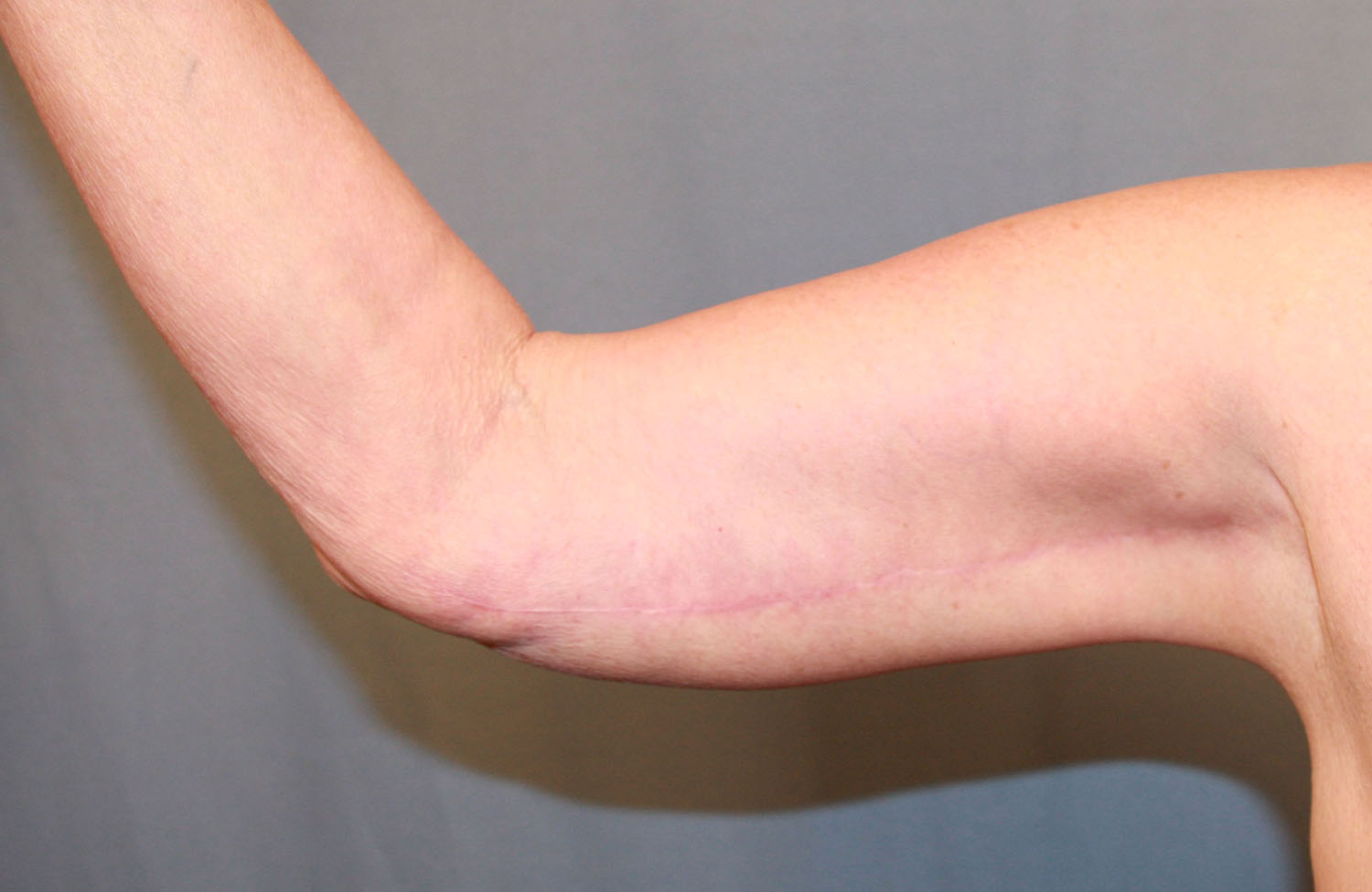 After Image: Brachioplasty - front