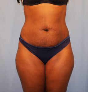 Before Image: Tummy Tuck