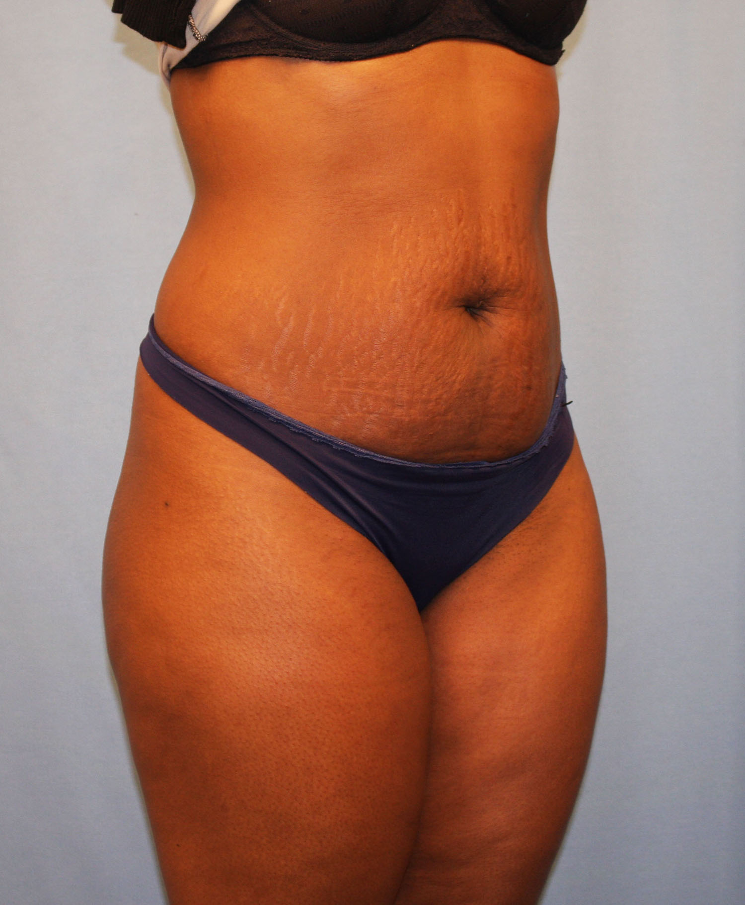 Before Image: Tummy Tuck - right-front-oblique