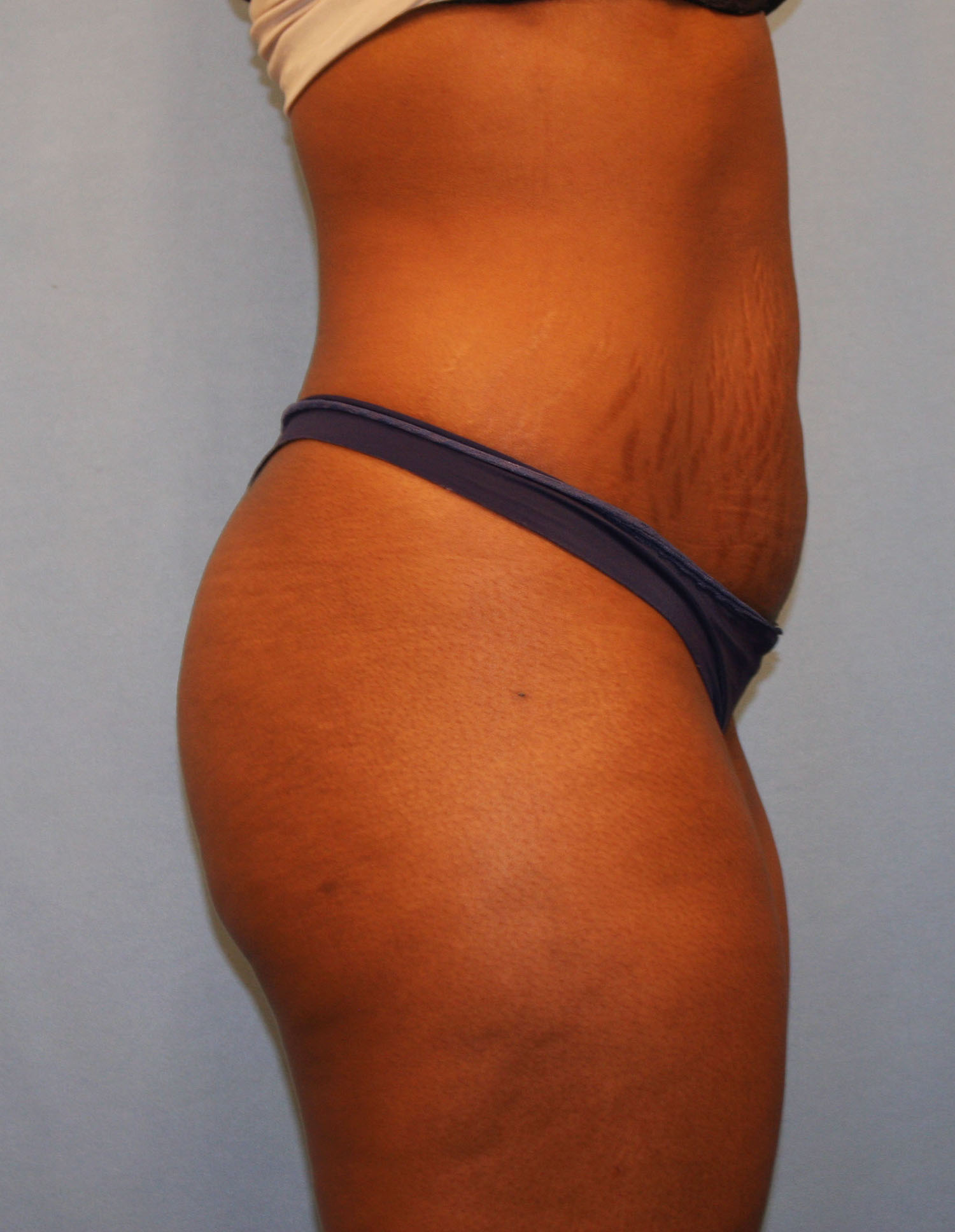 Before Image: Tummy Tuck - right-side