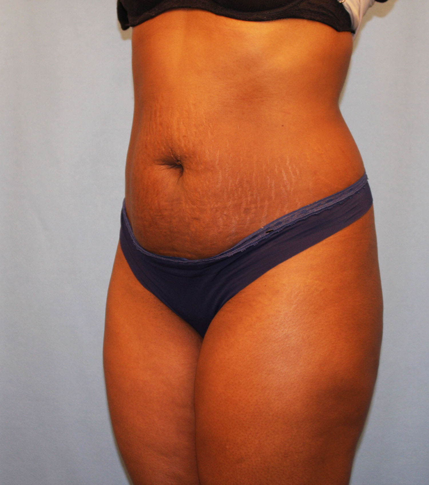 Before Image: Tummy Tuck - left-front-oblique