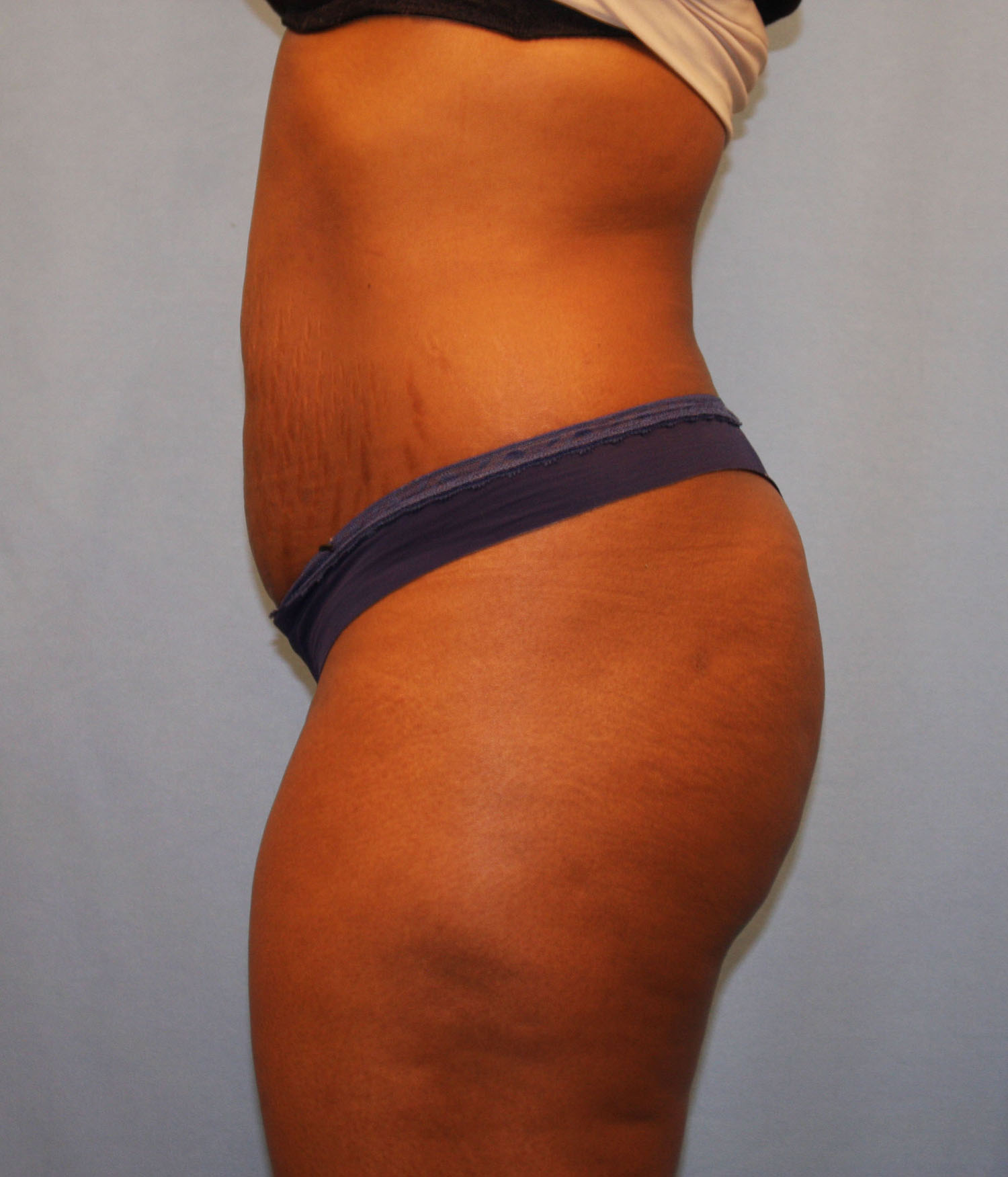 Before Image: Tummy Tuck - left-side