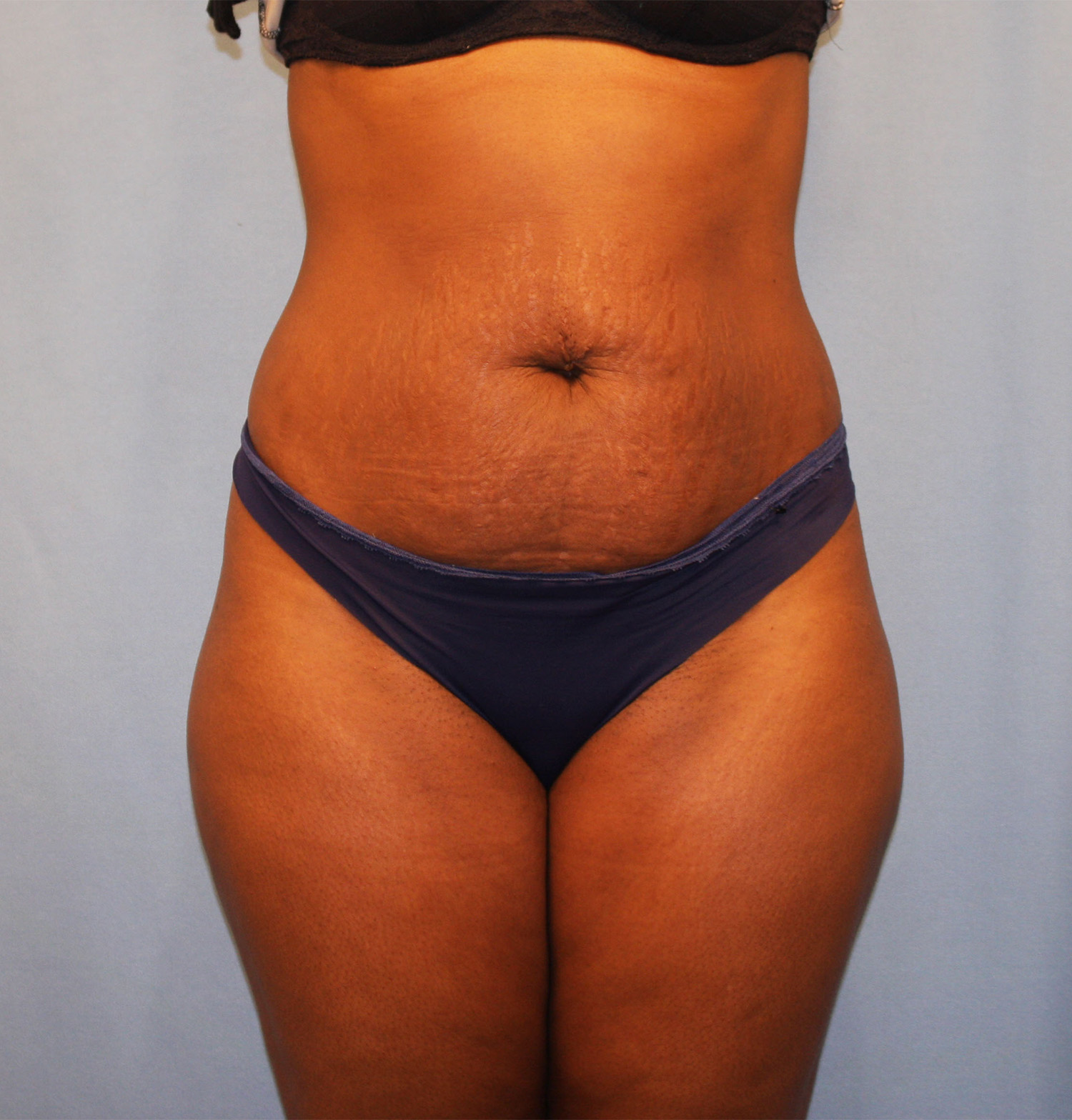 Before Image: Tummy Tuck - front