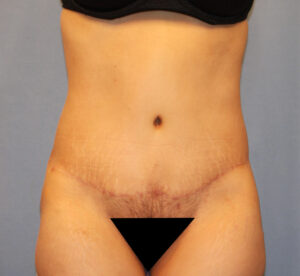 After Image: Tummy Tuck