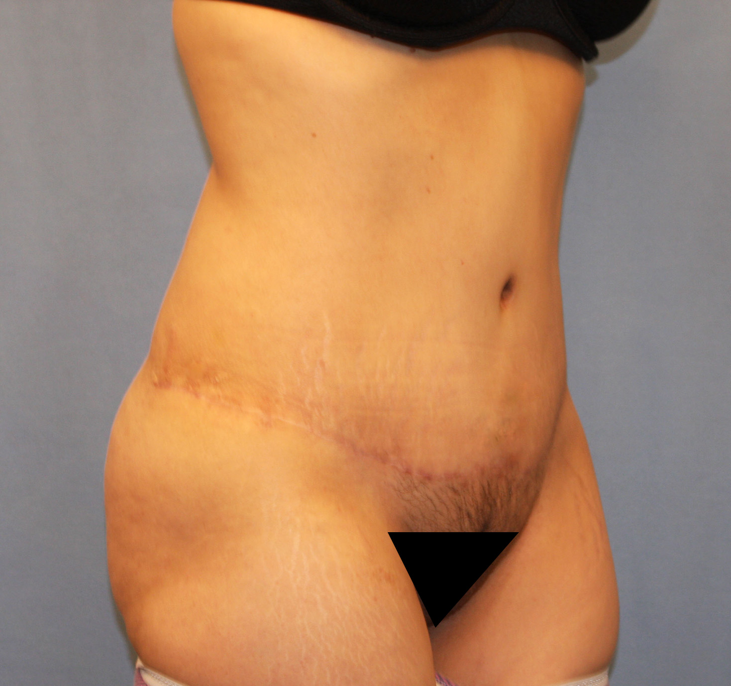 After Image: Tummy Tuck - right-front-oblique