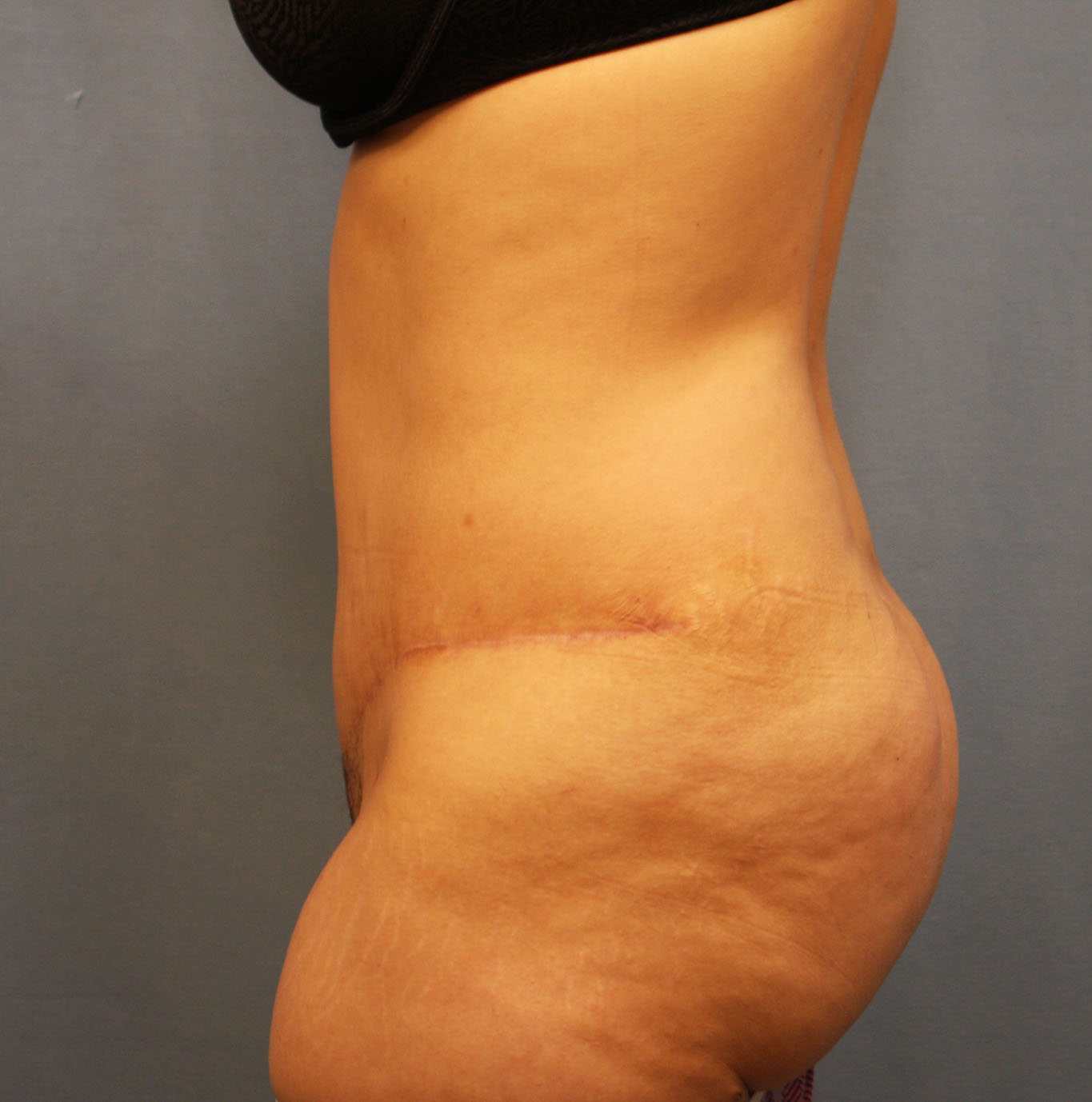 After Image: Tummy Tuck - left-side