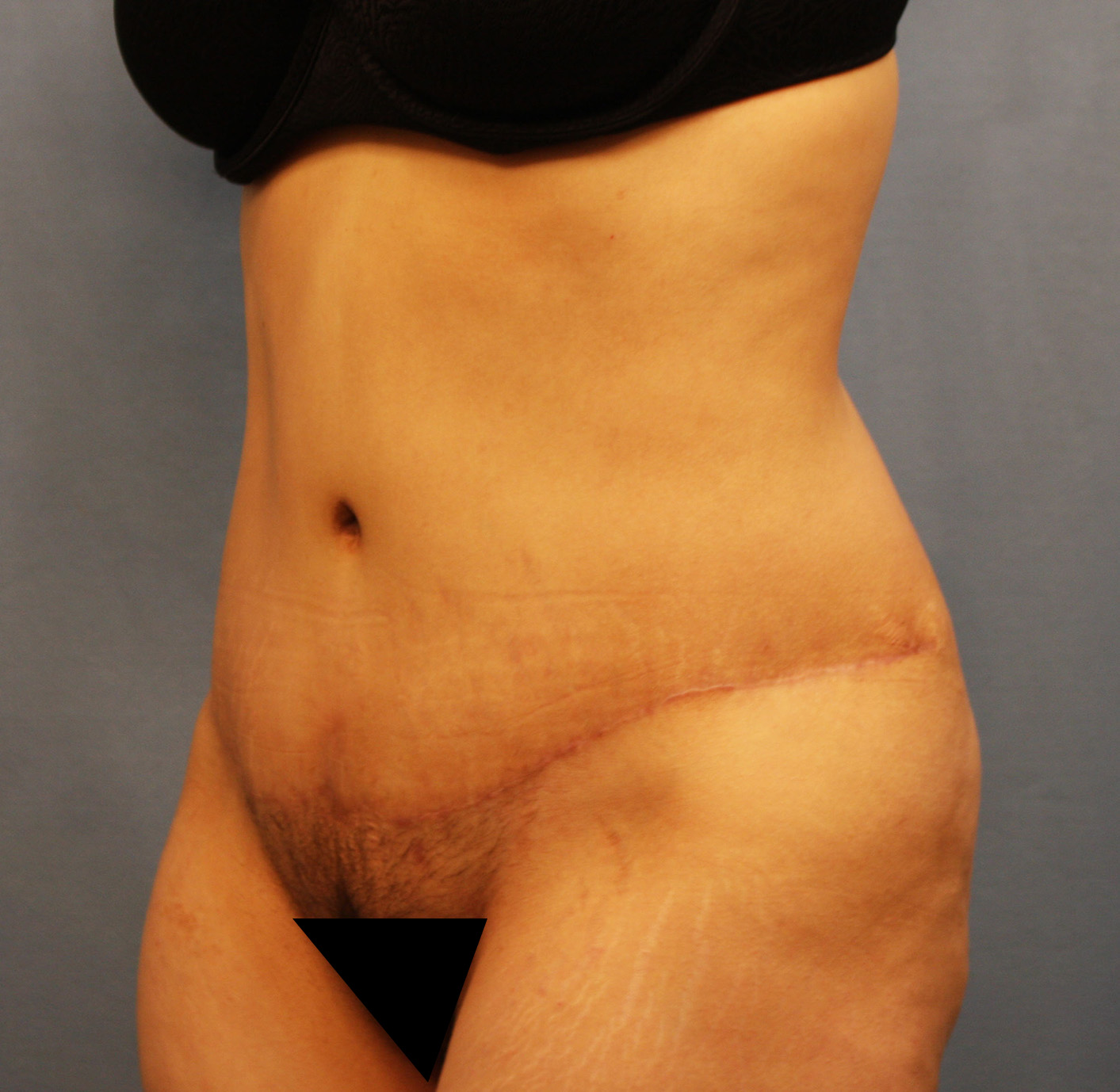 After Image: Tummy Tuck - left-front-oblique