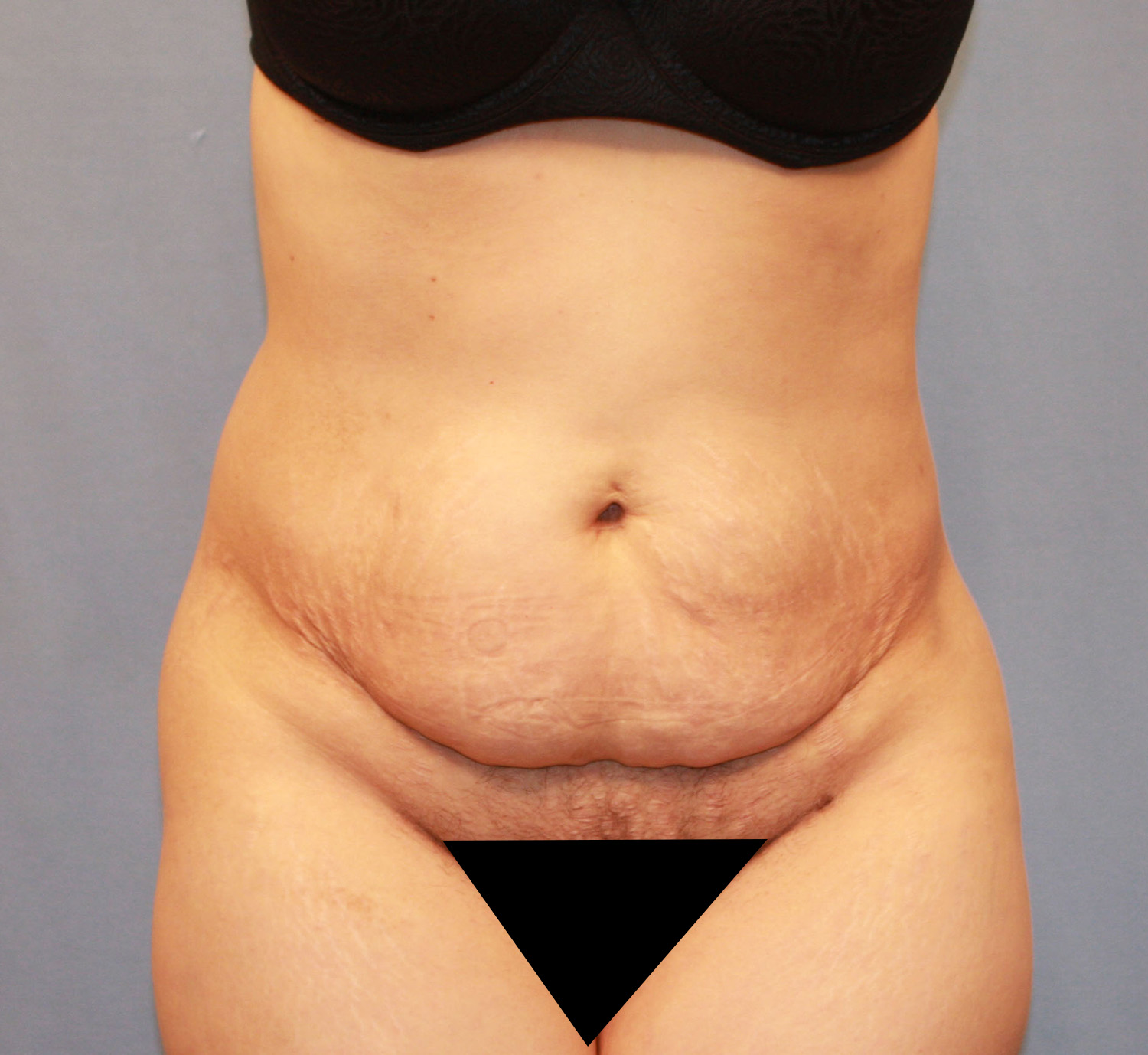 Before Image: Tummy Tuck - front